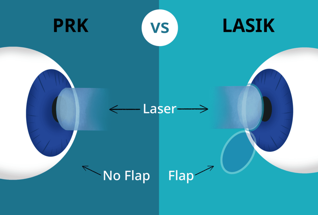 PRK vs LASIK